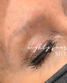 8445-Med-Spa-Brow2-Before