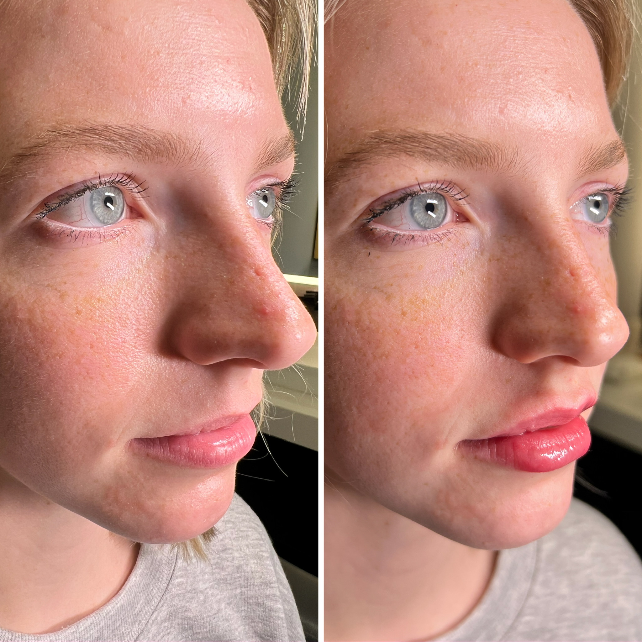 Lip Filler