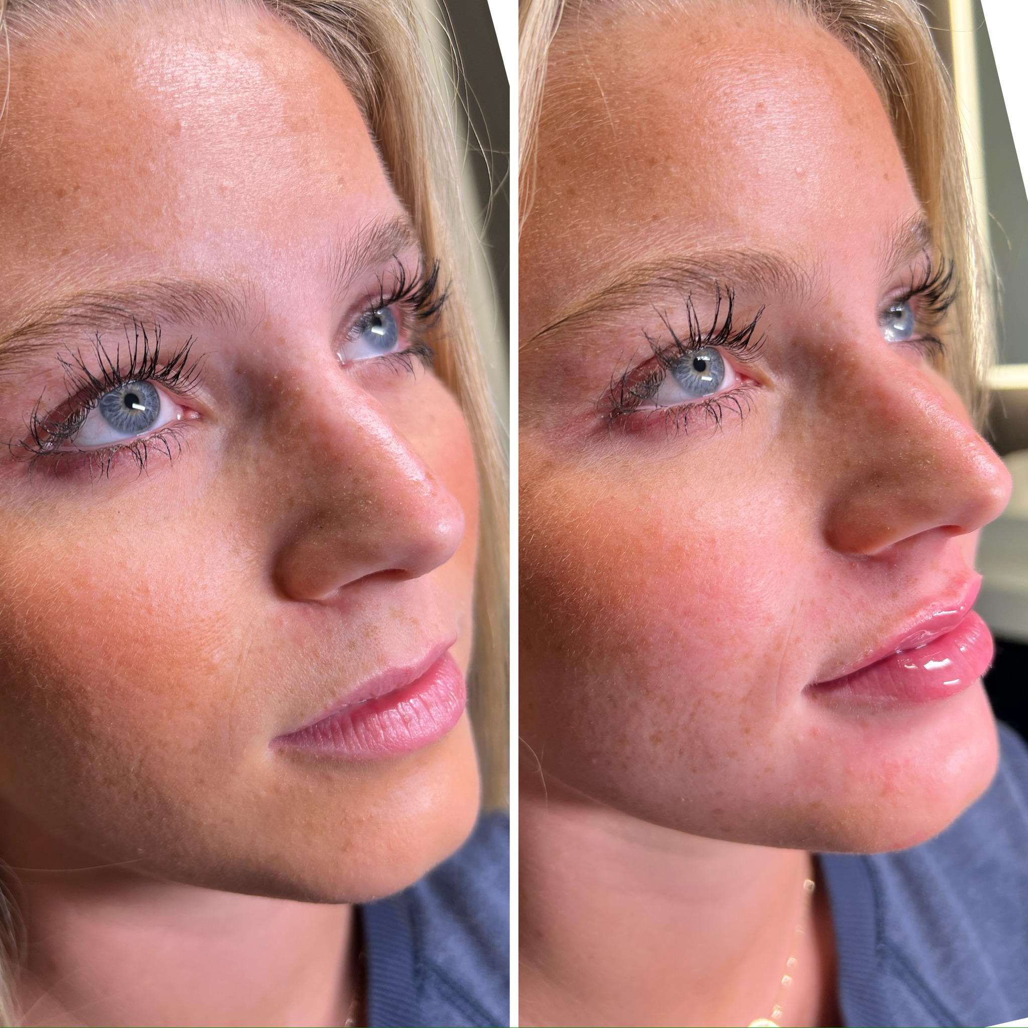 Lip Filler