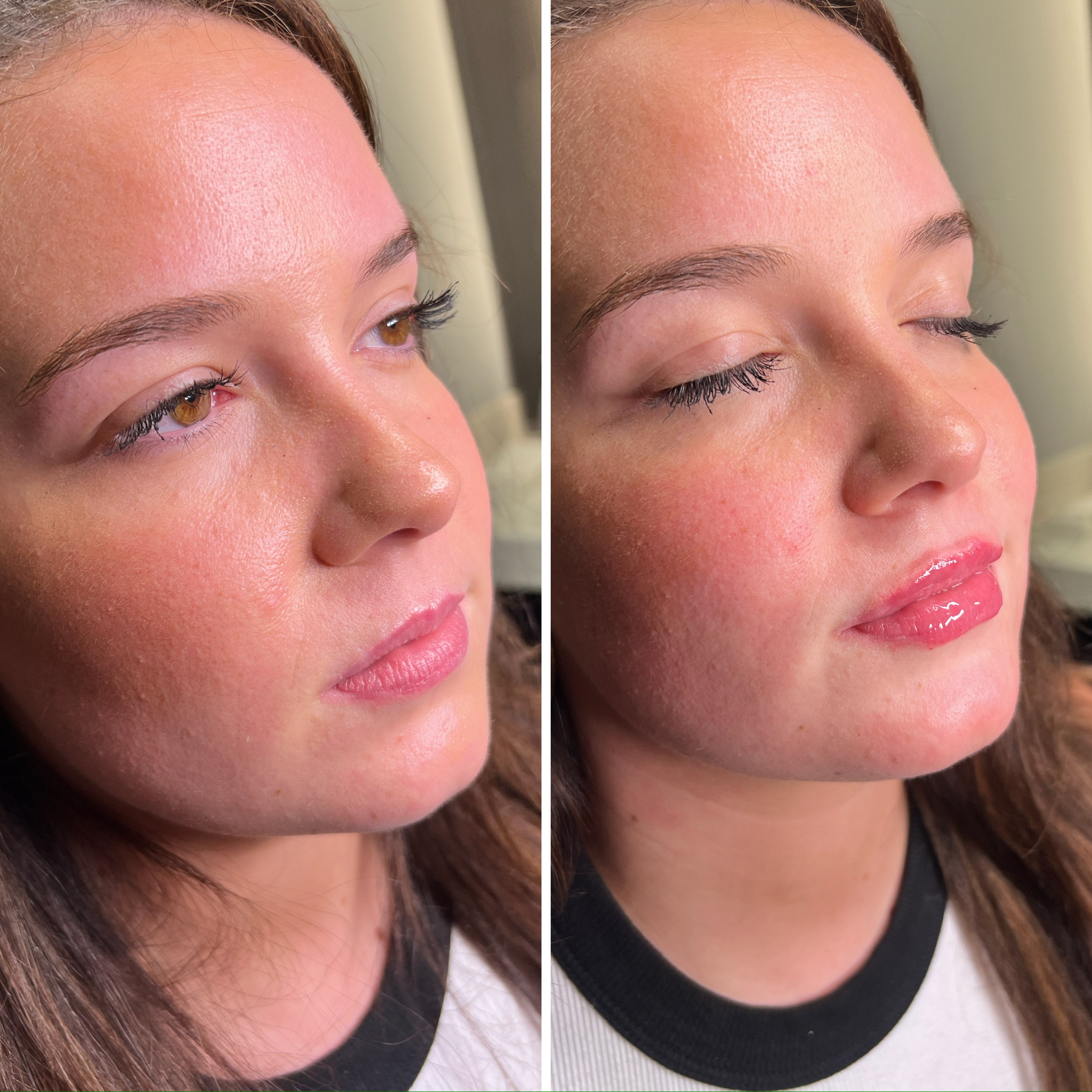 Lip Filler
