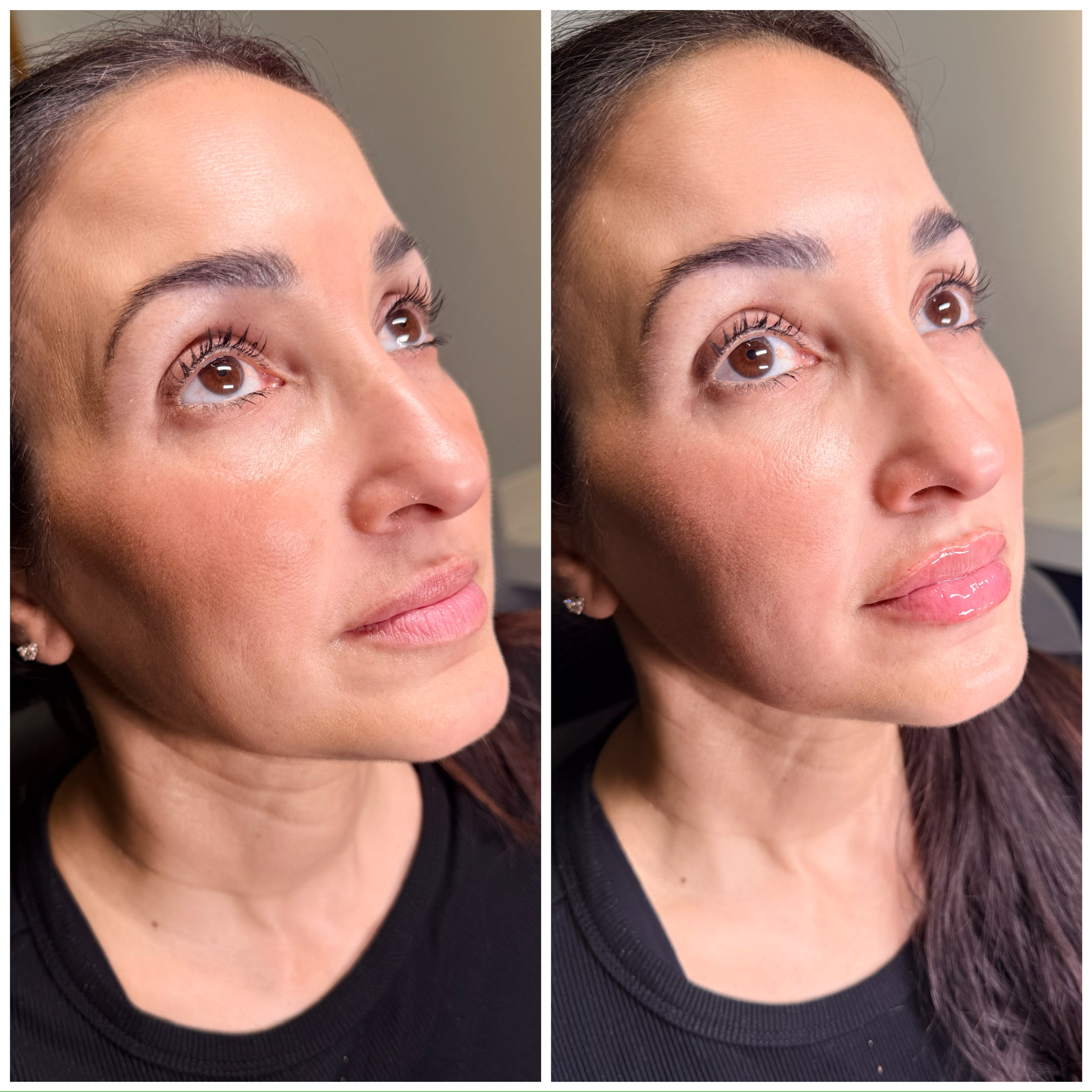 Lip Filler