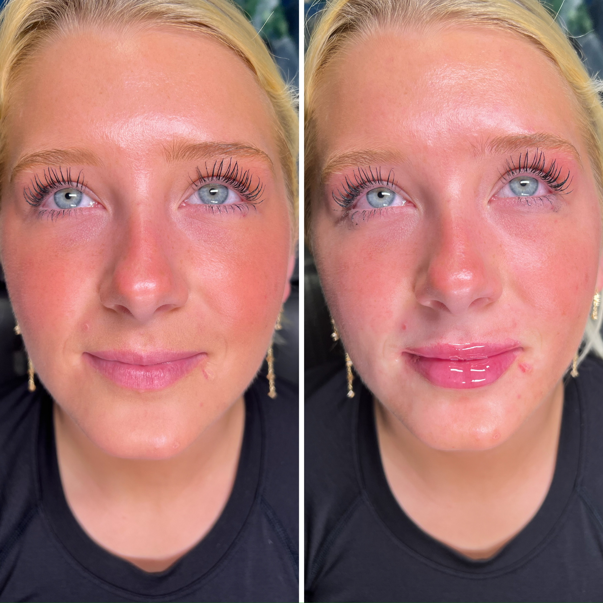 Lip Filler